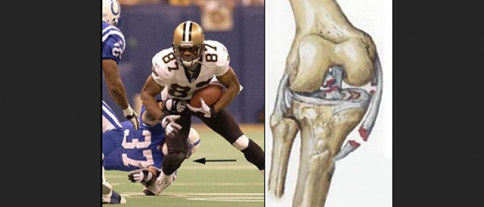 Mecanismos de lesión de partes blandas de rodilla: Ligamentos y meniscos.