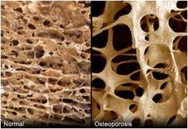 Osteoporosis: el ejercicio físico como aliado de tus medicamentos