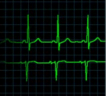 Monitoreo de la Frecuencia Cardiaca Durante el Sueño