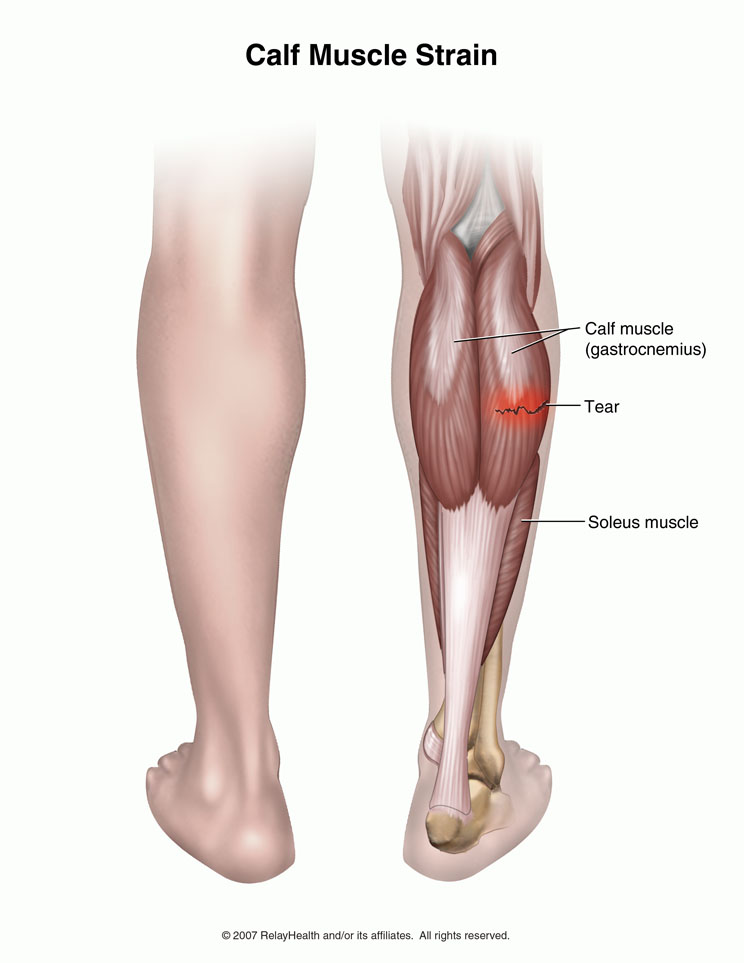 Artículo sobre las Lesiones musculares de gemelo vs sóleo: Como diferenciar y manejar las lesiones musculares de la pantorrilla