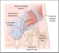 Artículo sobre Sport Hernia