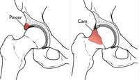 Artículo sobre el Impingement Femoro Acetabular