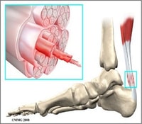 Terapia Física para la Tendinopatia de Aquiles: Revisión Sistemática y Meta-análisis.