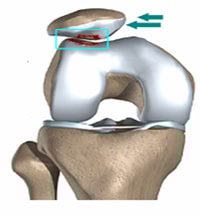 ¿Qué es el síndrome Patelofemoral o PFPS?