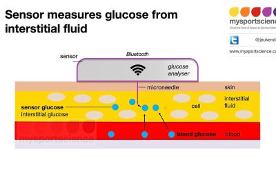 ¿Son precisos los monitores continuos de glucosa (MCG)?