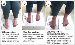 Análisis detallado del arco transverso del pie hallux valgus con y sin dolor mediante imágenes por ultrasonido en carga y sensores de fuerza precisos