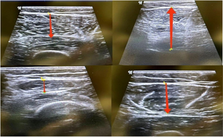 Investigación de los efectos de la terapia de masaje de percusión sobre el dolor, la funcionalidad, el diámetro muscular y la propiocepción en los individuos con reconstrucción de LCA: un ensayo controlado aleatorizado