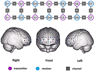 Combinando estimulación transcraneal de corriente directa y entrenamiento cognitivo computarizado para la recuperación cognitiva post-ictus: Protocolo de estudio para un ensayo controlado aleatorizado con secuencias de intervención temporal optimizadas