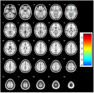 El ejercicio aeróbico agudo aumenta la actividad cortical durante la memoria de trabajo: un estudio de resonancia magnética funcional en estudiantes universitarias