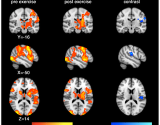 Impacto de una sola sesión de ejercicio aeróbico en la perfusión cerebral regional y las respuestas de activación en adultos jóvenes sanos