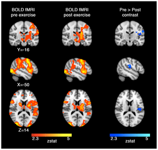 Impacto de una sola sesión de ejercicio aeróbico en la perfusión cerebral regional y las respuestas de activación en adultos jóvenes sanos